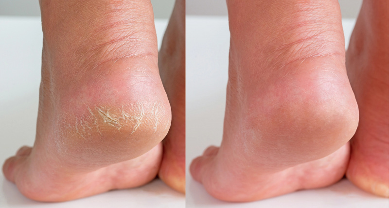 amazon-gehwol-med-skin-salve-crack-feet