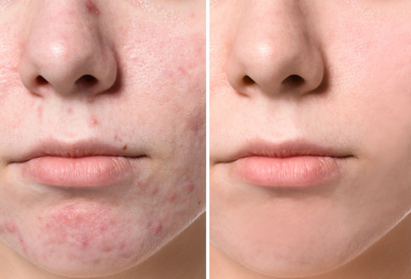 Före-Efter-Acne-Klar-Hud