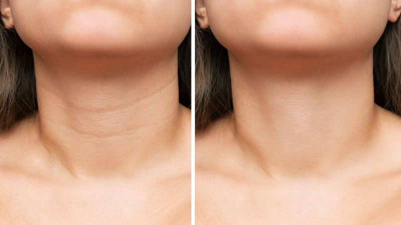 amazon-blumbody-neck-smoothing-pads